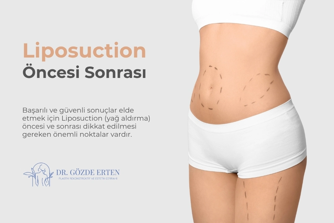 Liposuction Öncesi Sonrası Nelere Dikkat Edilmeli? Liposuction Öncesi Sonrası Nelere Dikkat Edilmeli?