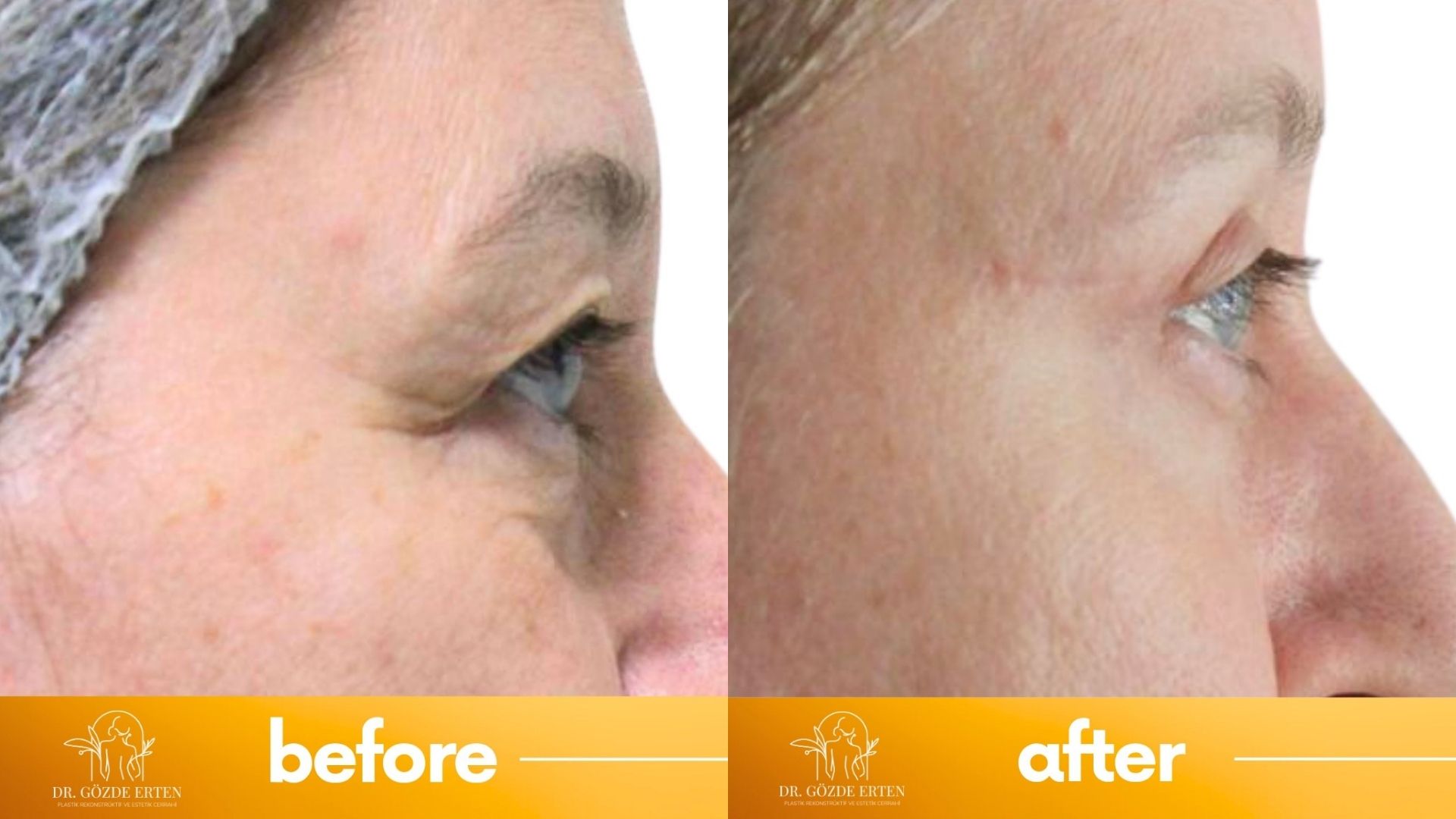 Eyelid surgery before and after in Turkey, Ankara Eyelid surgery before and after in Turkey, Ankara