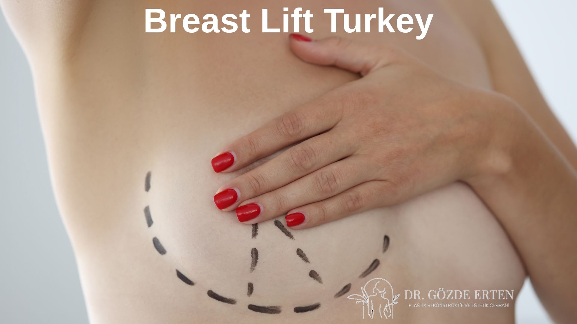 Breast Lift Frequently Asked Questions (FAQs in Turkey 