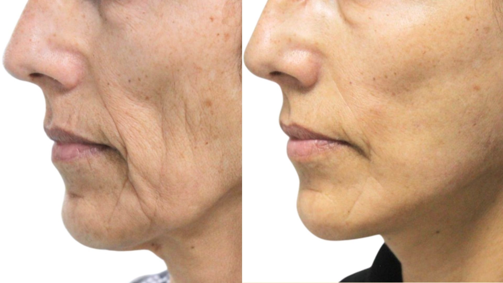 Buccal Fat Removal Before and After Buccal Fat Removal Before and After