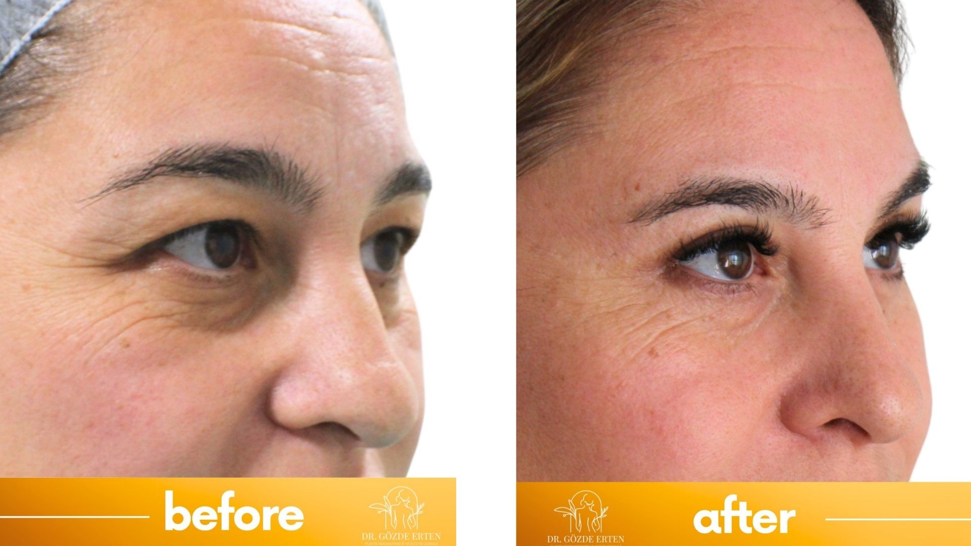 Eyelid surgery before and after-1 Eyelid surgery before and after-1
