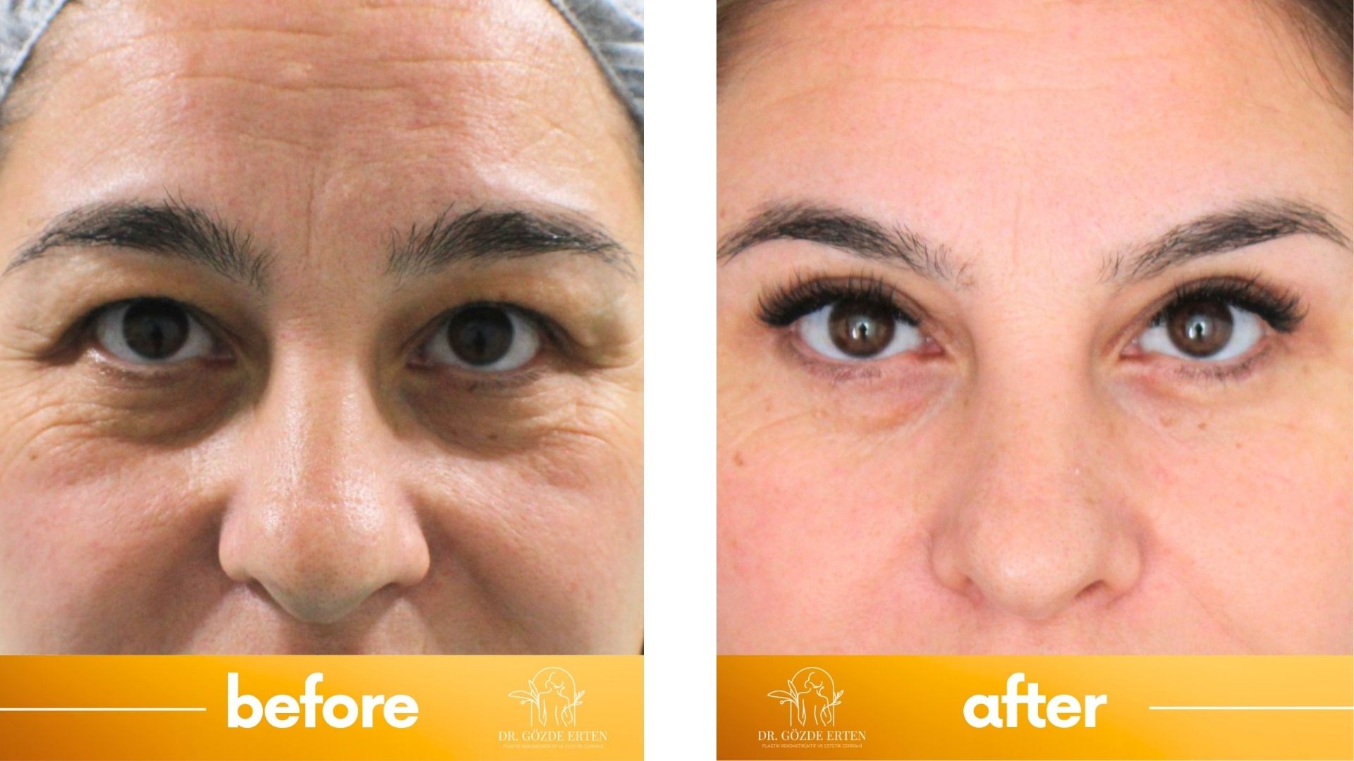 Eyelid surgery before and after-2 Eyelid surgery before and after-2