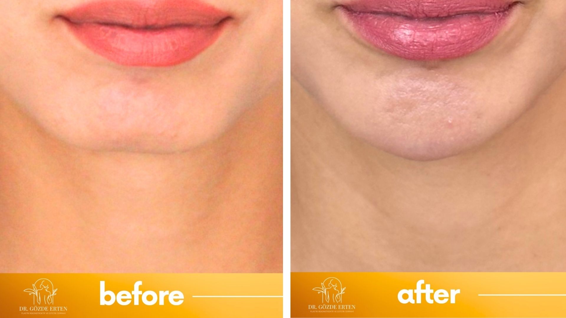 jaw-filler-before-after