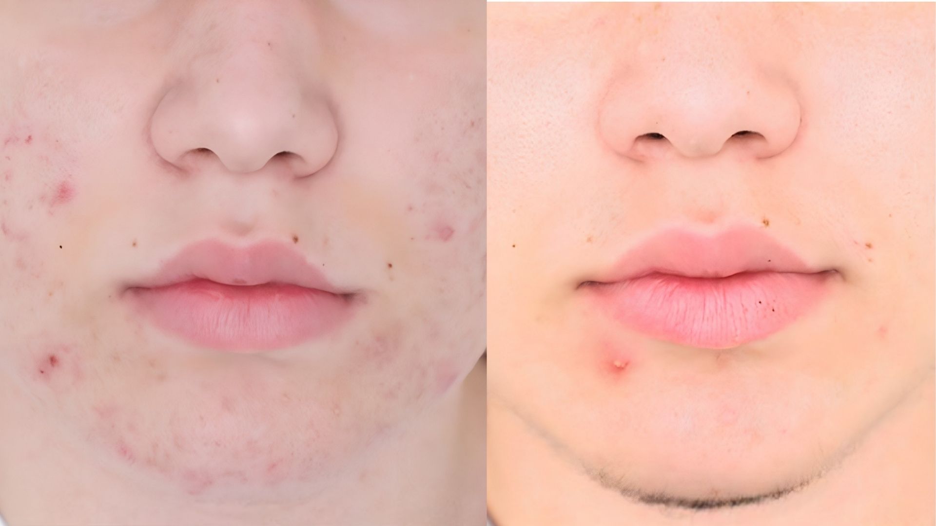 Laser acne treatment Turkey before and after-1