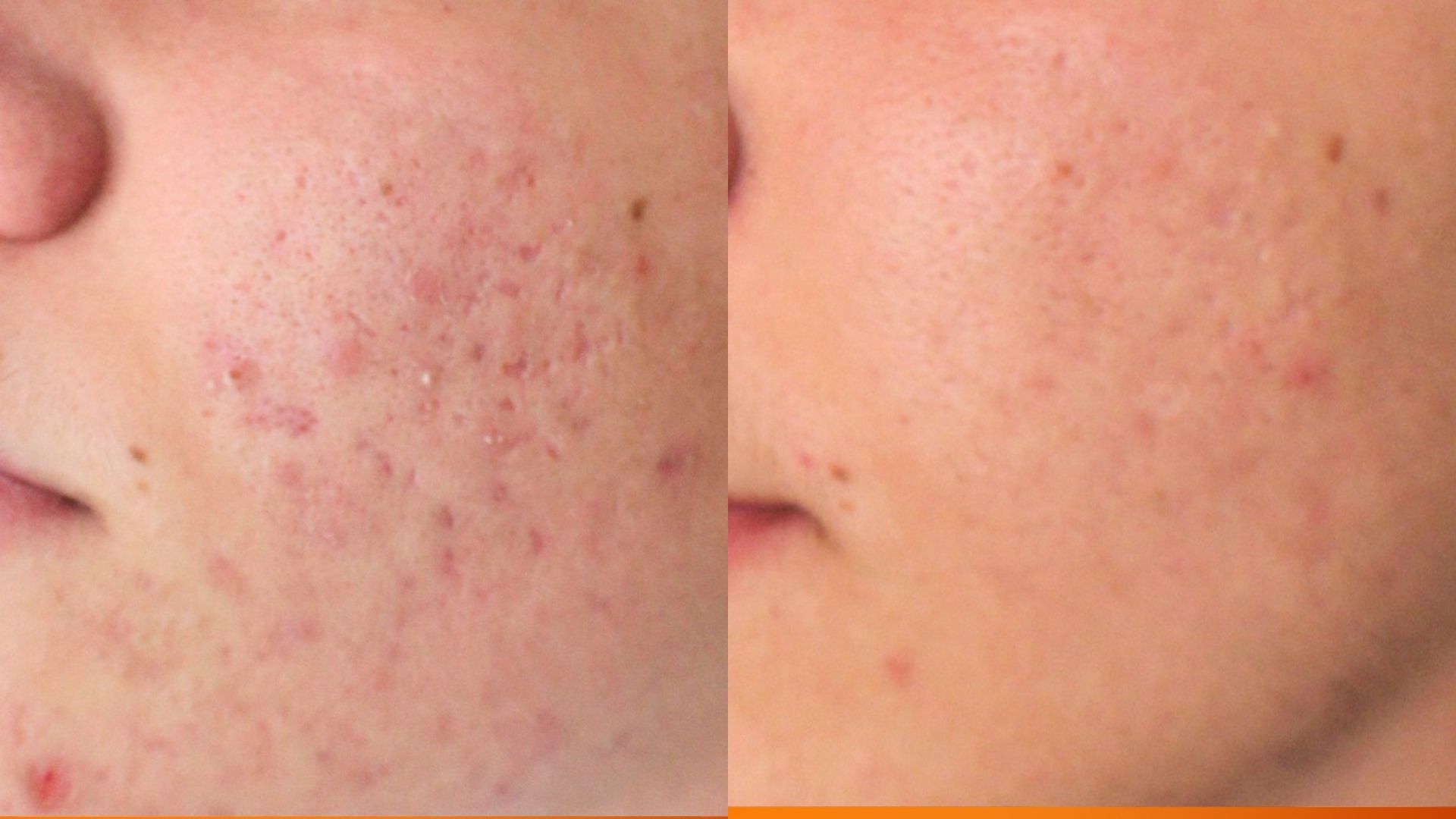 Laser acne treatment Turkey before and after-2