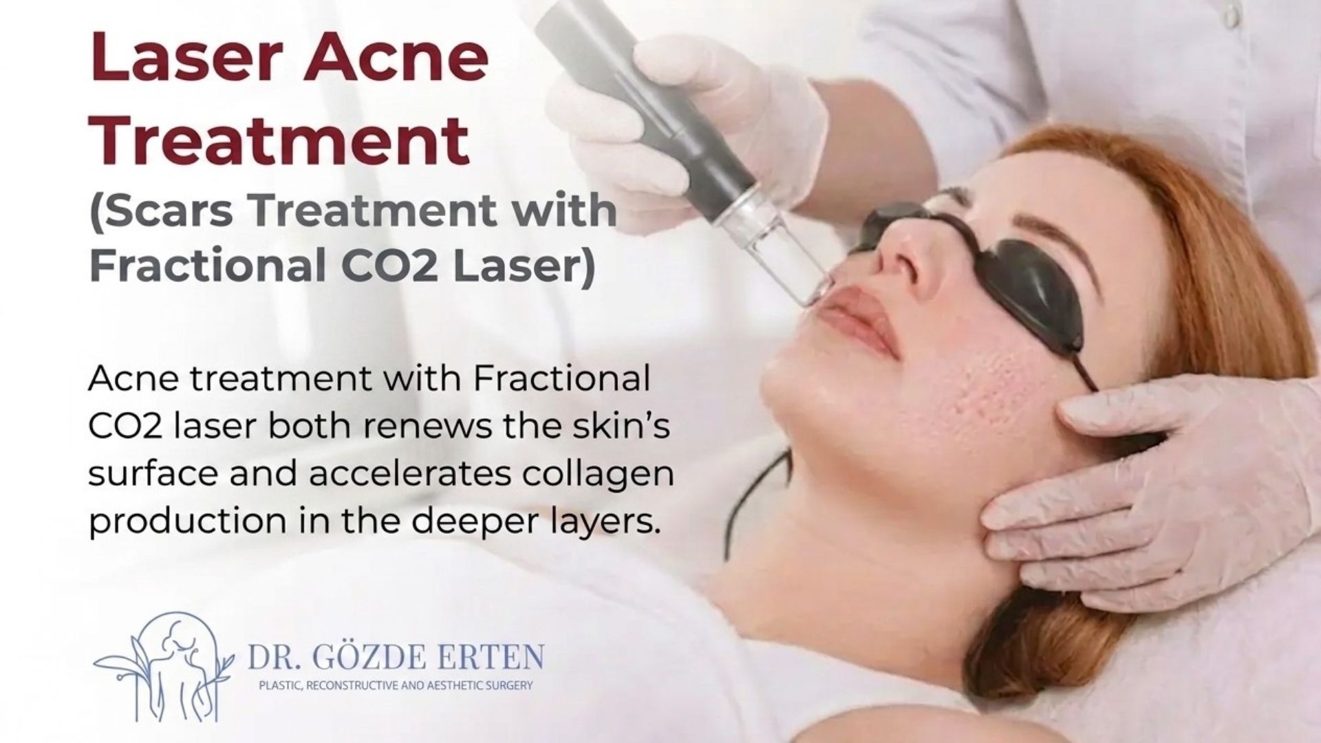 laser-acne-treatment-turkey-ankara