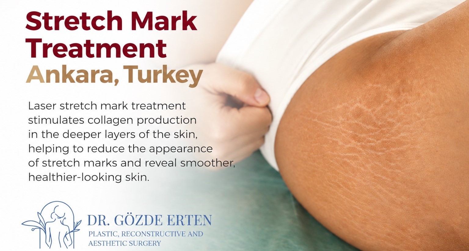 laser-stretch-mark-treatment-ankara-turkey