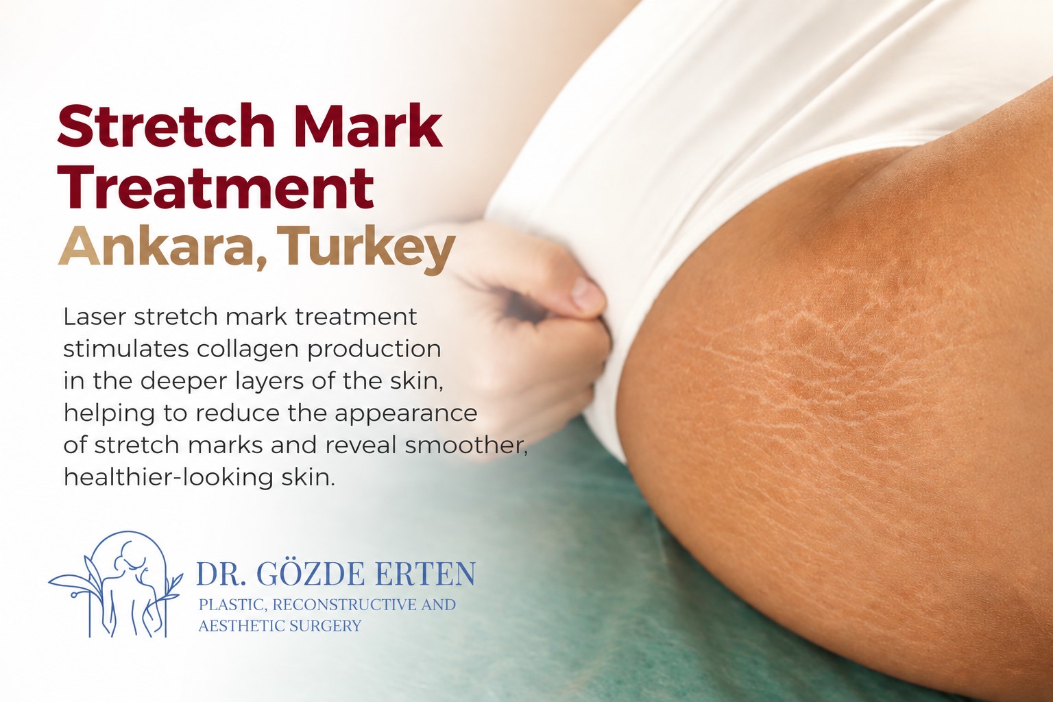 Laser stretch mark treatment in Ankara, Turkey
