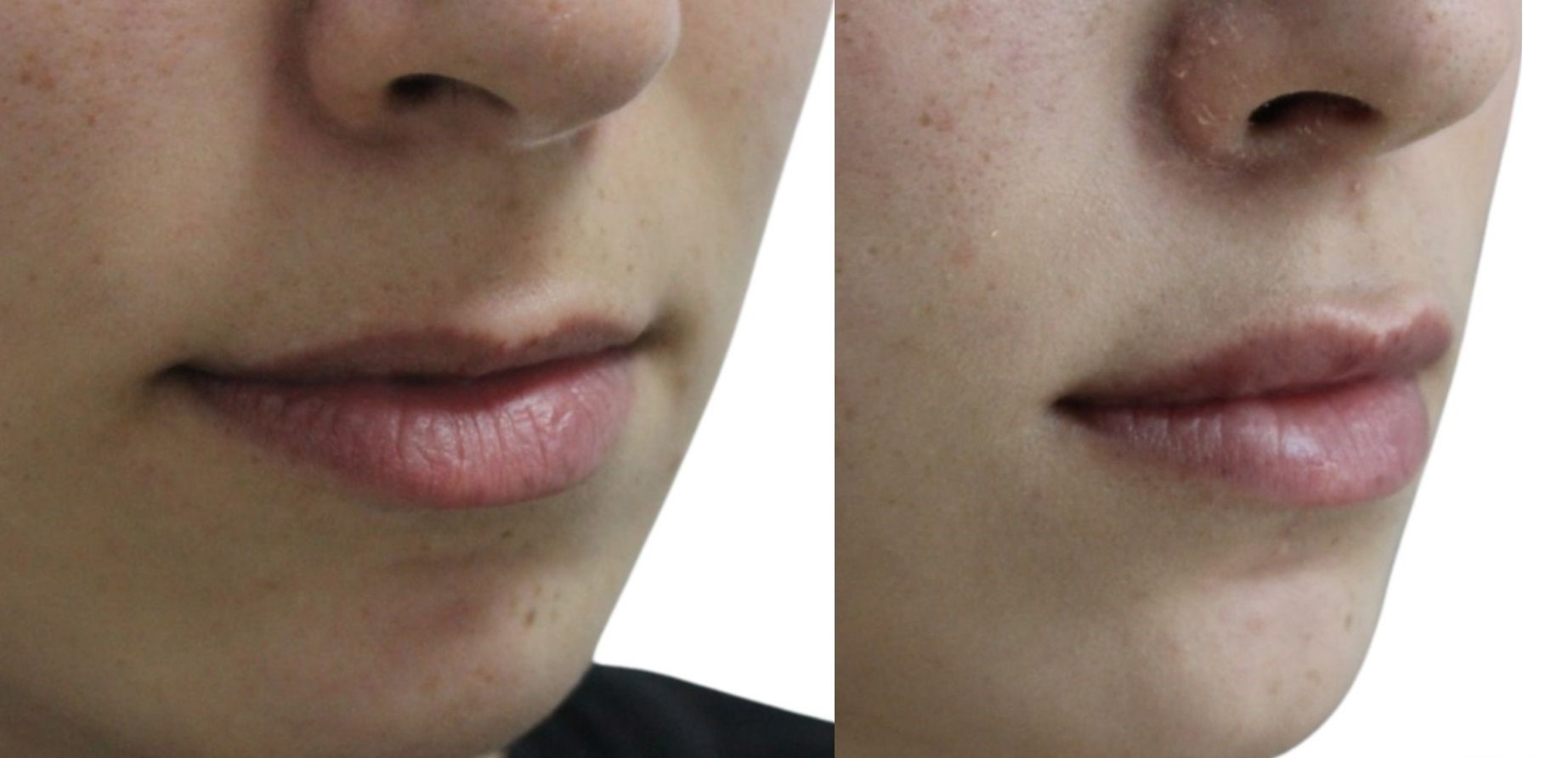 lip-filler-before-after-1 lip-filler-before-after-in-turkey-ankara-1
