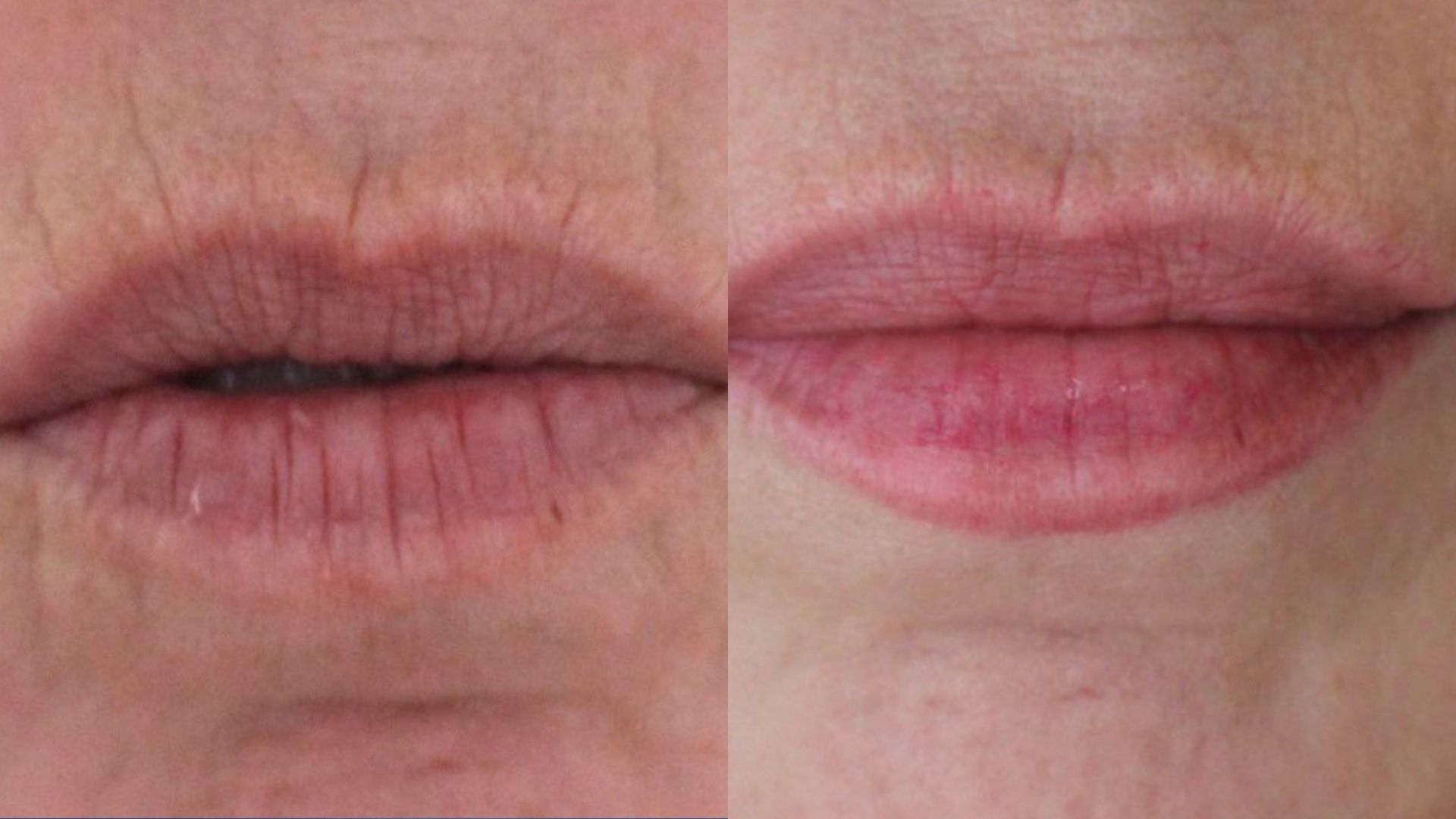lip-filler-before-after-in-turkey-ankara-2