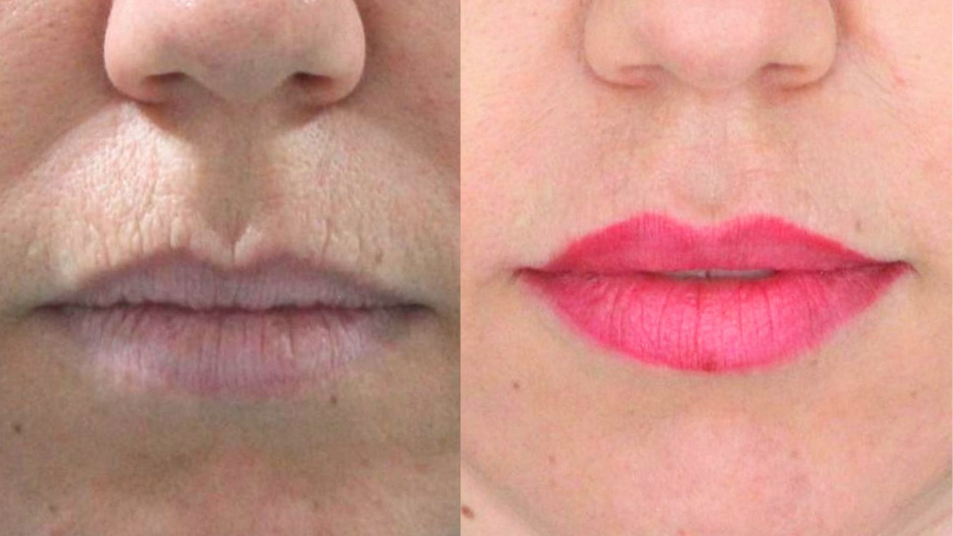 lip-filler-before-after-in-turkey-ankara-3