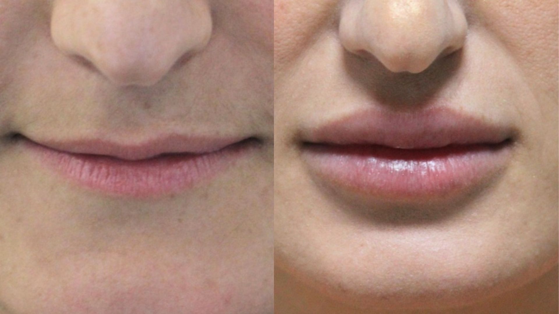 lip-filler-before-after-in-turkey-ankara lip-filler-before-after-in-turkey-ankara