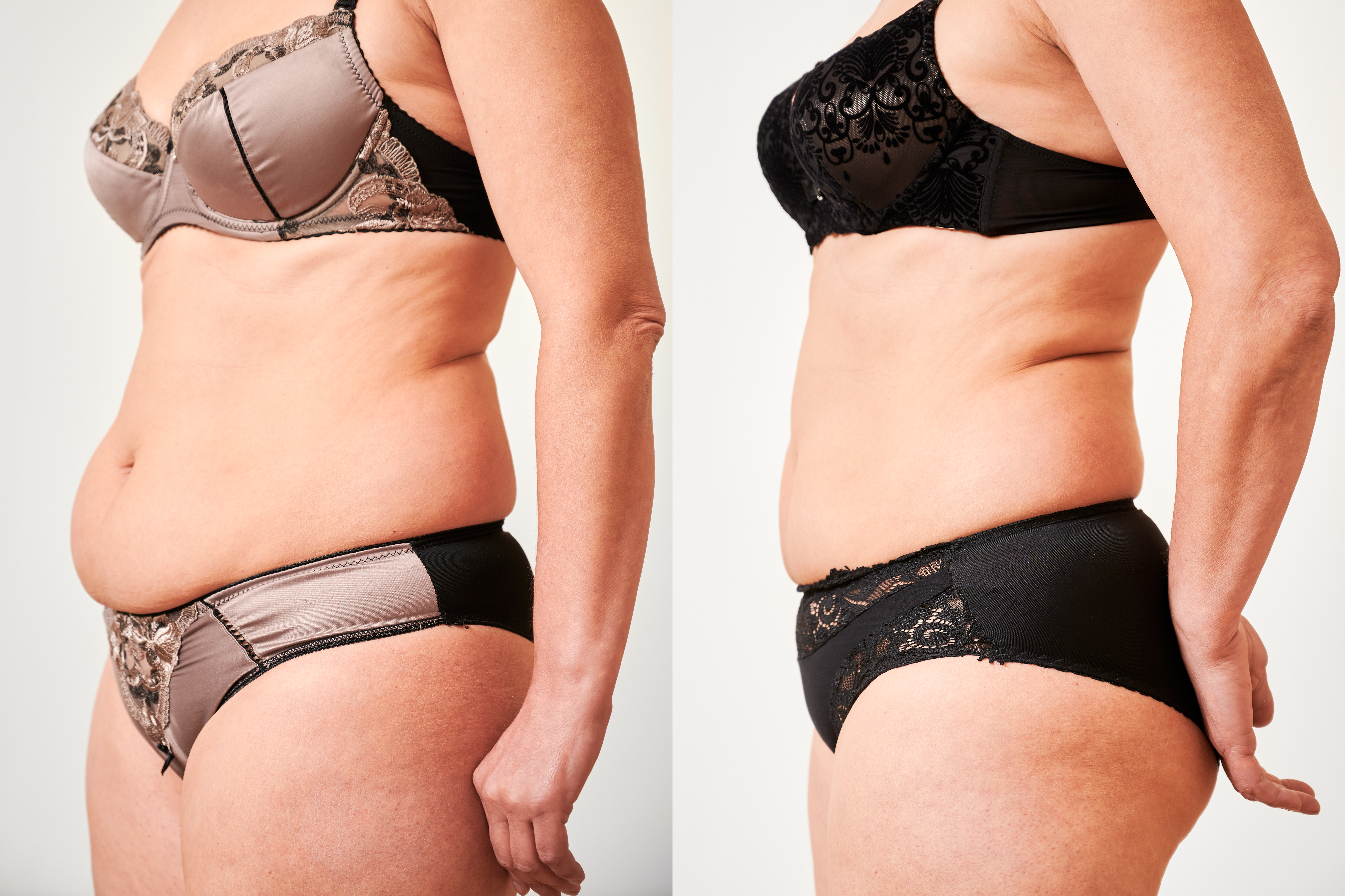iposuction before and after in Turkey-2 iposuction before and after in Turkey-2