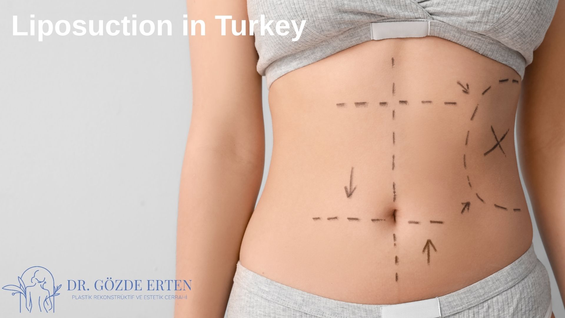 is-it-safe-to-have-liposuction-in-turkey