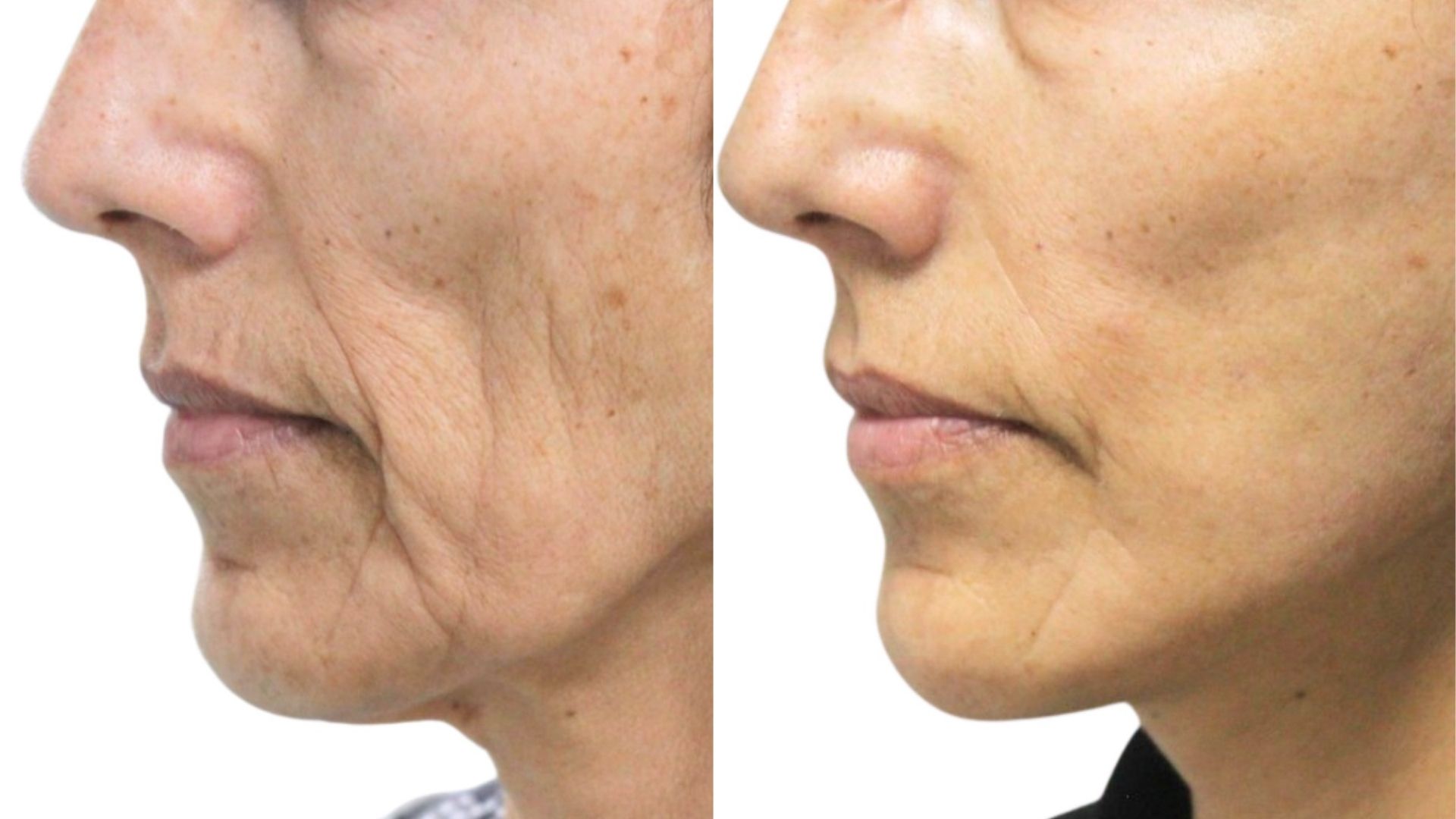 mini-facelift-turkey-before-after mini-facelift-turkey-before-after
