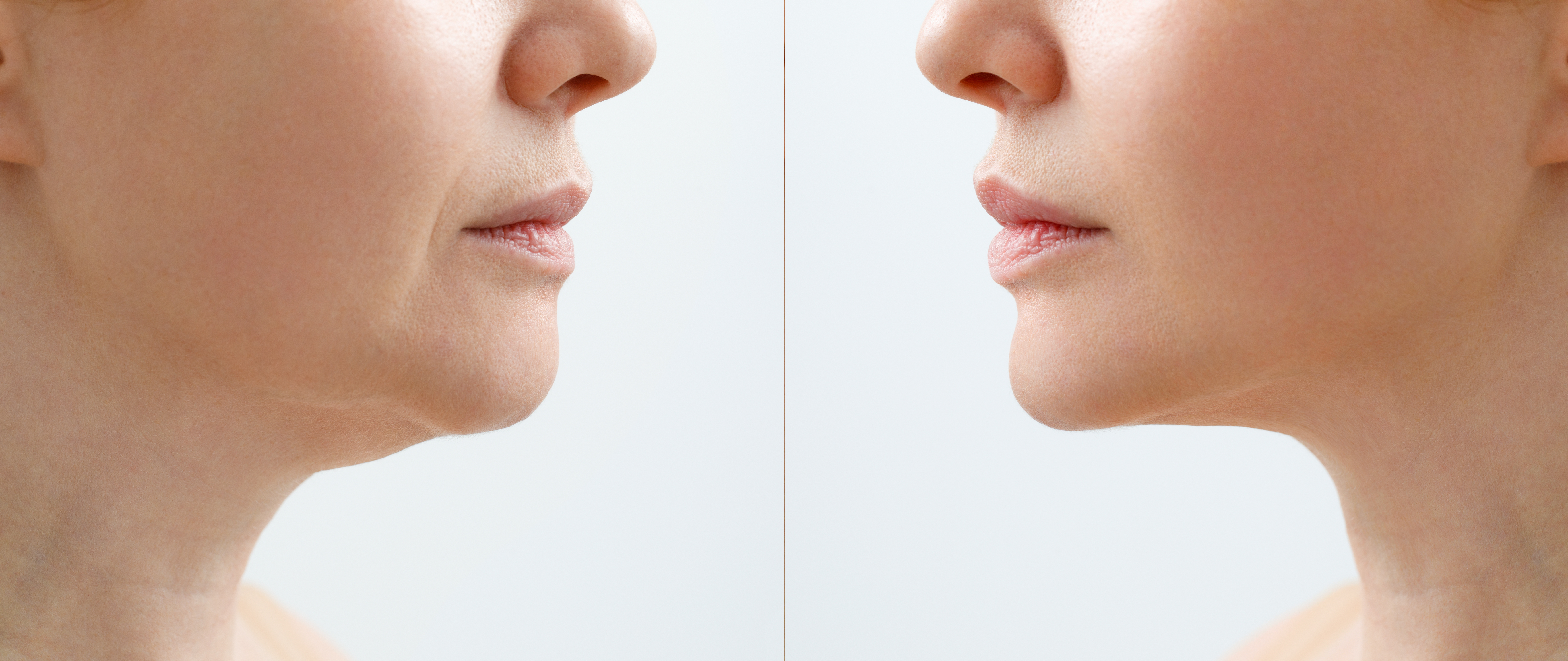mini-facelift-turkey-before-after mini-facelift-turkey-before-after