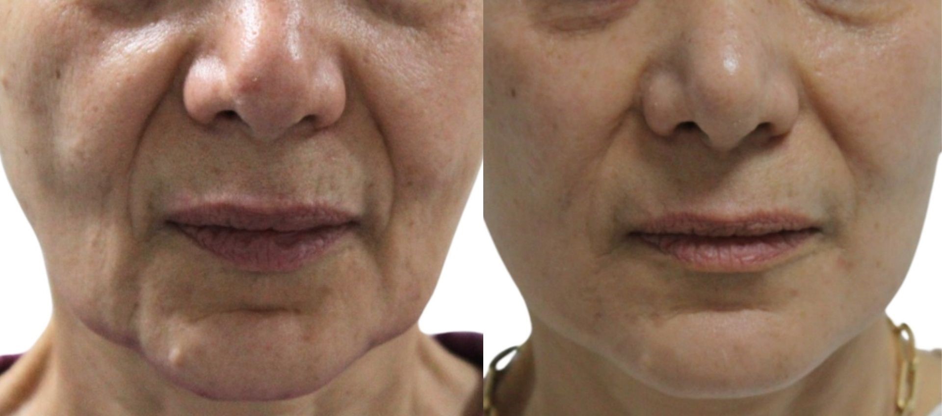mini-facelift-turkey-before-after-1 mini-facelift-turkey-before-after-1