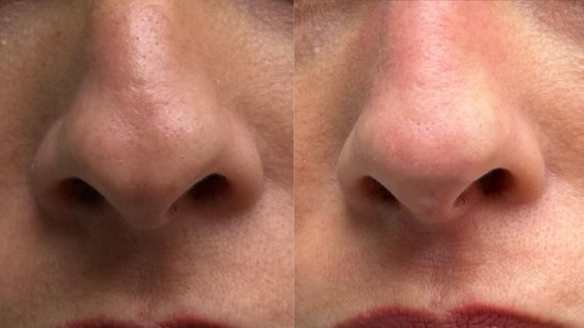 nose-filler-before-after-1 nose-filler-before-after-1-in-turkey-ankara