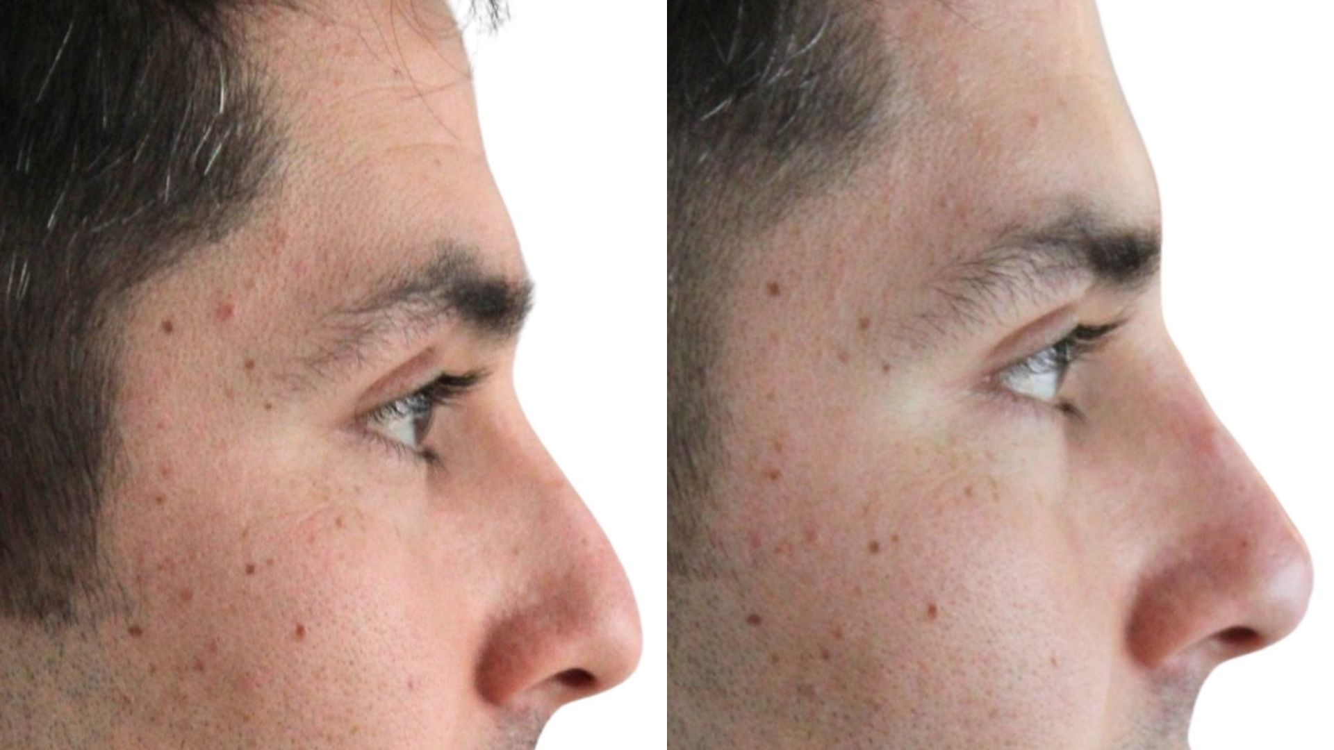 nose-filler-before-after-in-turkey-ankara nose-filler-before-after-in-turkey-ankara