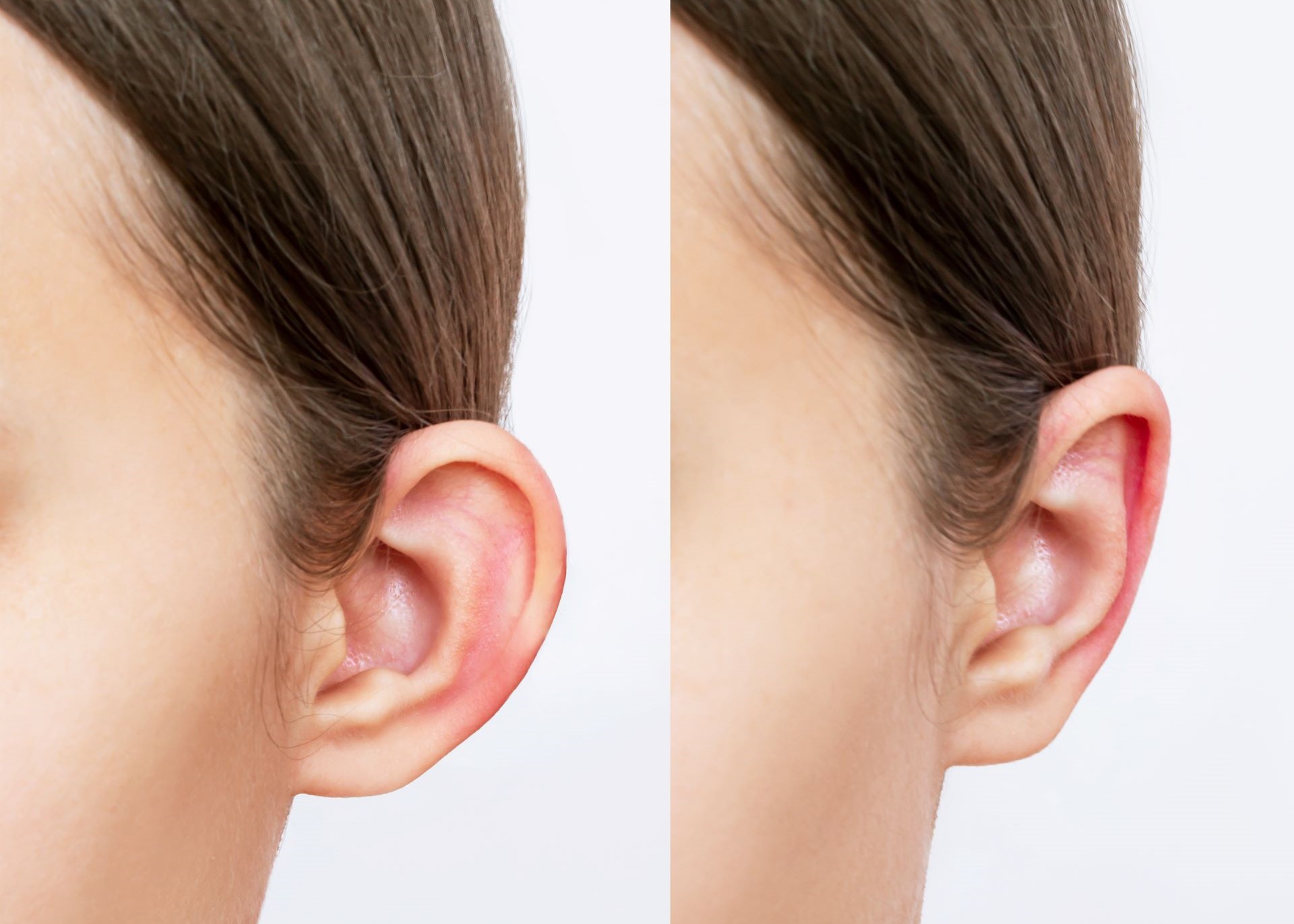 prominent-ears-before-after-1 in turkey