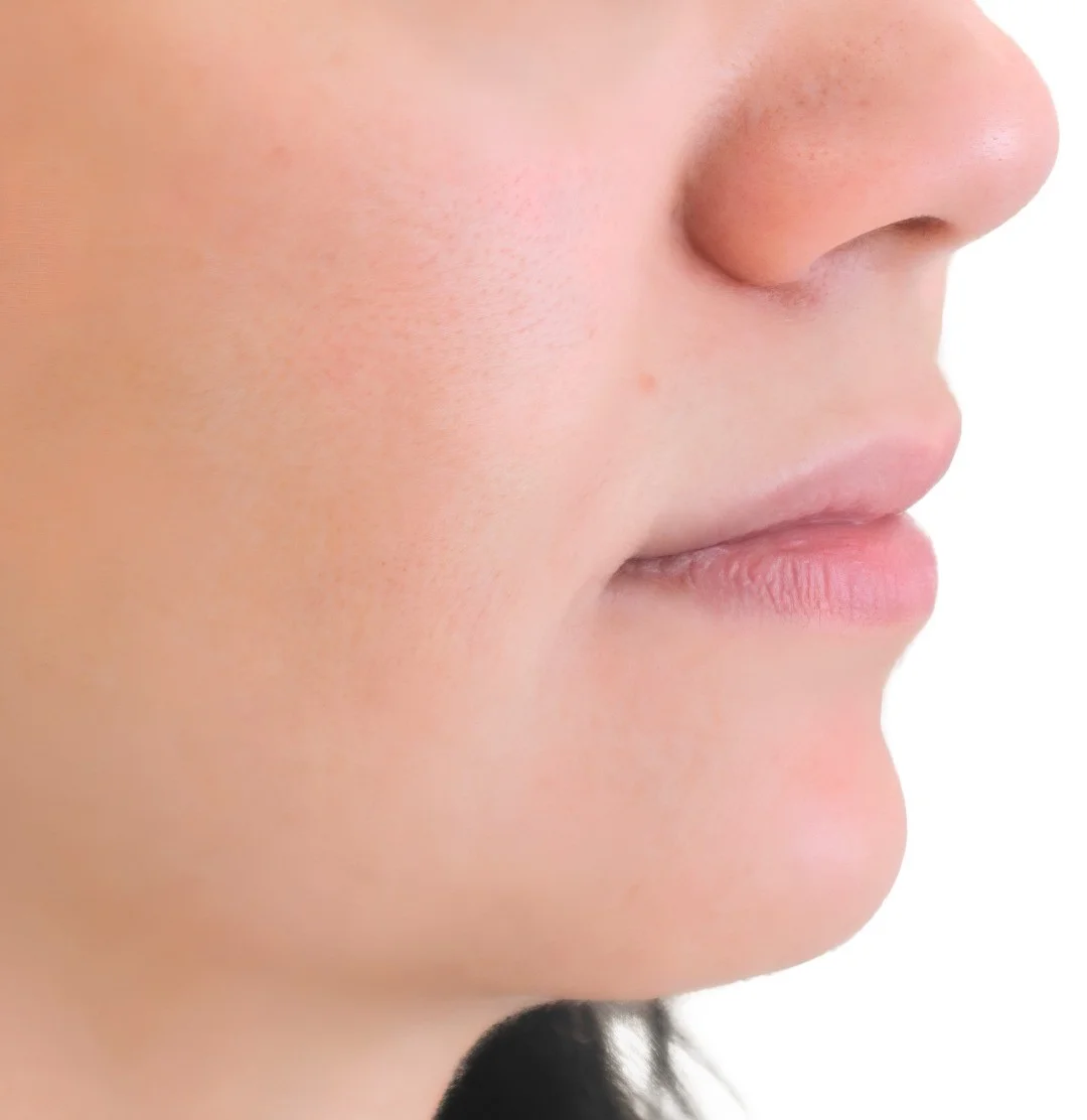 Radiesse after treatment in Ankara, Turkey