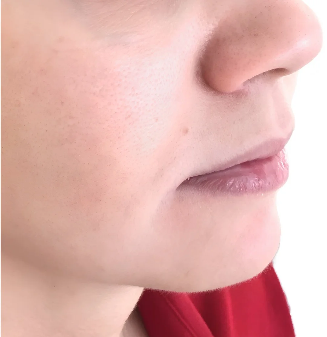 Radiesse before treatment in Ankara, Turkey
