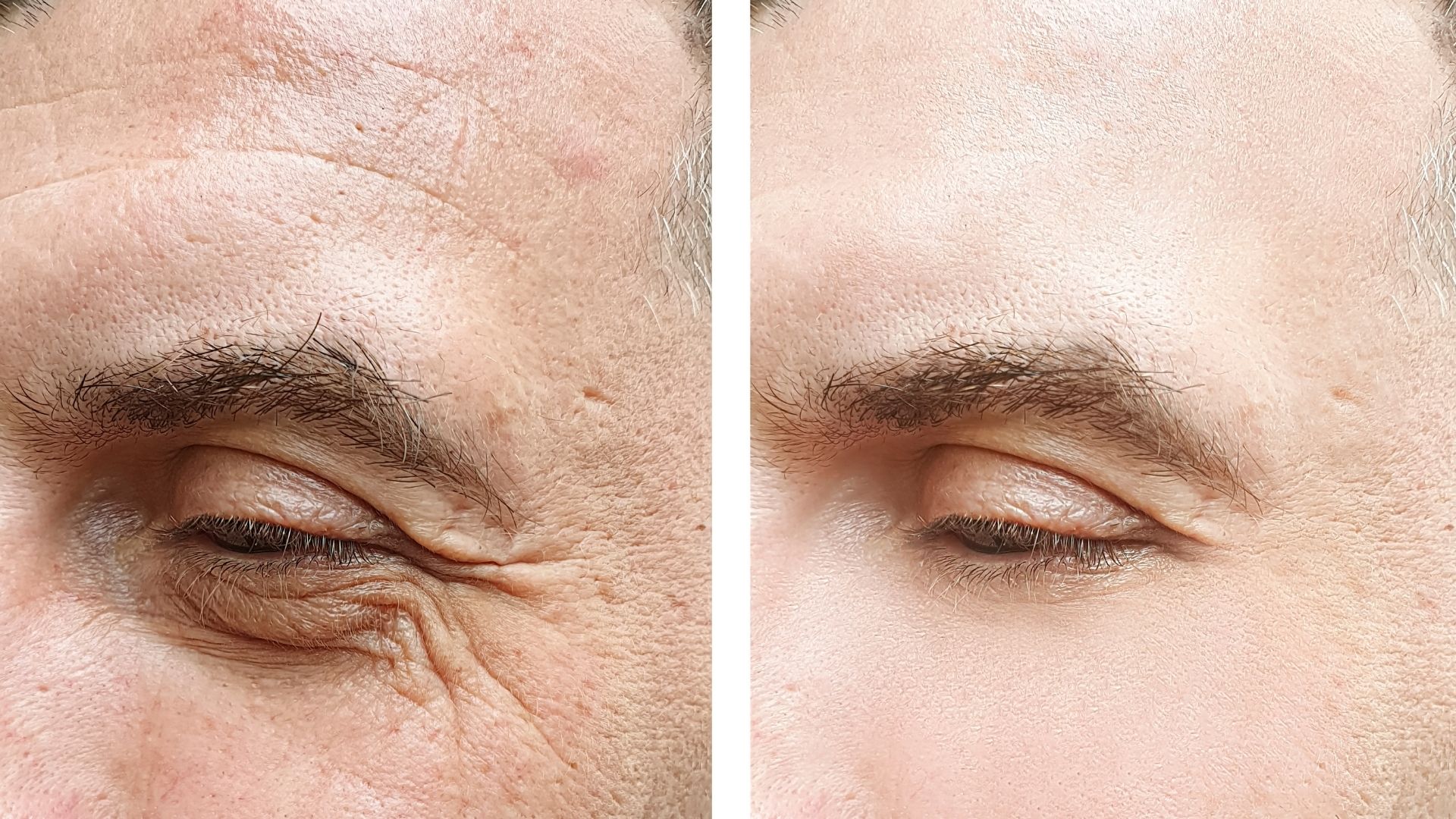 Temporal Lift Lateral Brow Lift Cost Before After In Turkey Ankara Temporal Lift Lateral Brow Lift Cost Before After In Turkey Ankara