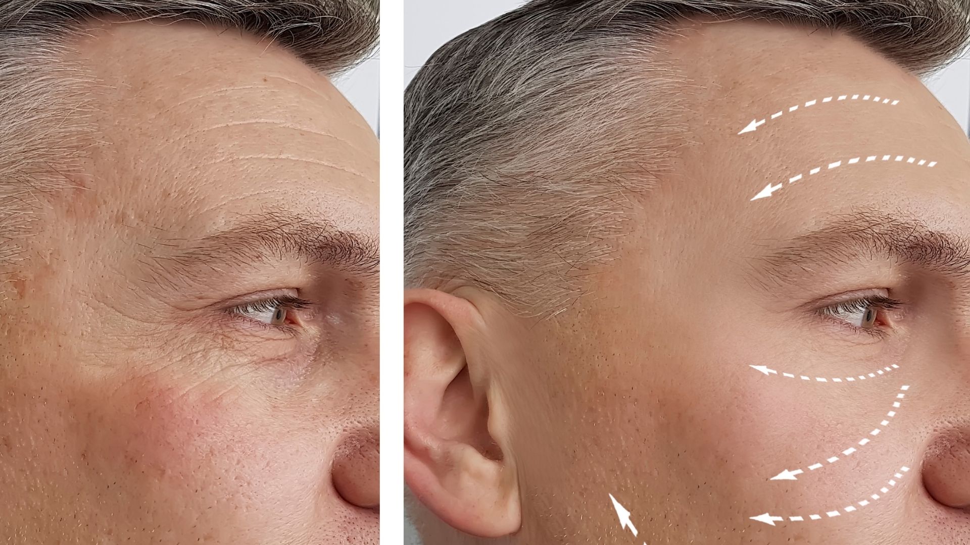Temporal Lift Lateral Brow Lift Cost Before After In Turkey Ankara Temporal Lift Lateral Brow Lift Cost Before After In Turkey Ankara
