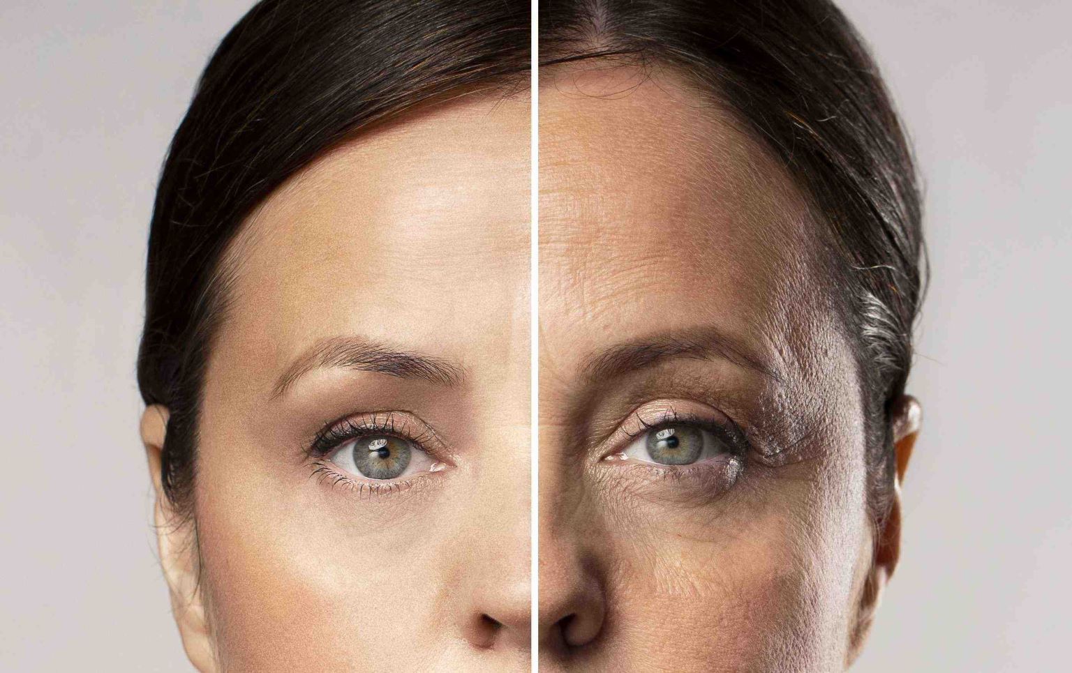 Endoscopic Temporal Lift Before and After Endoscopic Temporal Lift Before and After-1