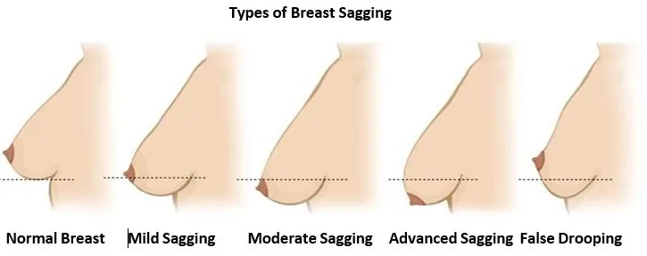 Types of breast sagging: normal breast, mild, moderate and advanced sagging, and false drooping