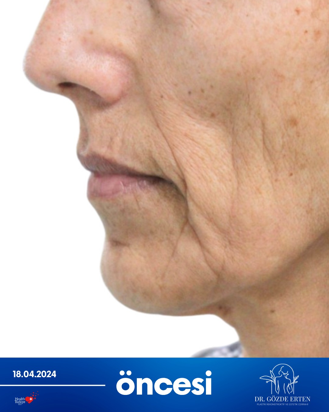 Mini Facelift before and after 1