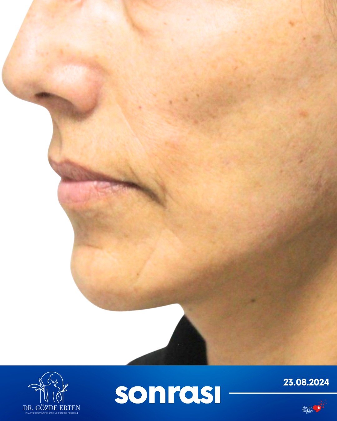 Mini Facelift before and after 2