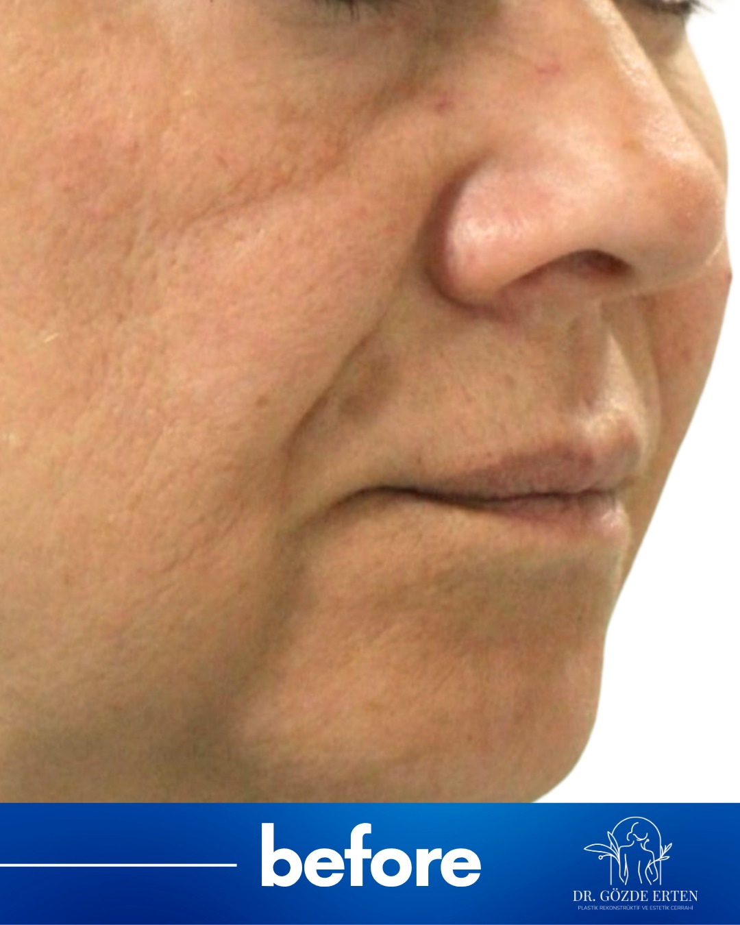 Mini Facelift before and after 3