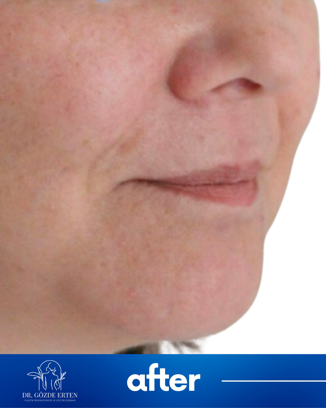 Mini Facelift before and after 4