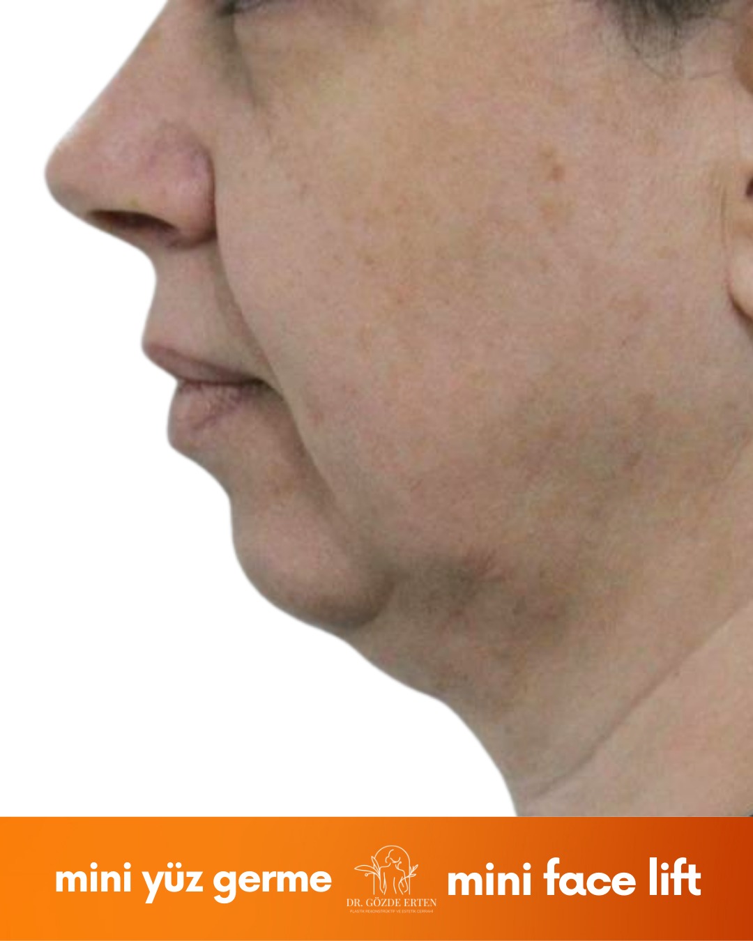 Mini Facelift before and after 5