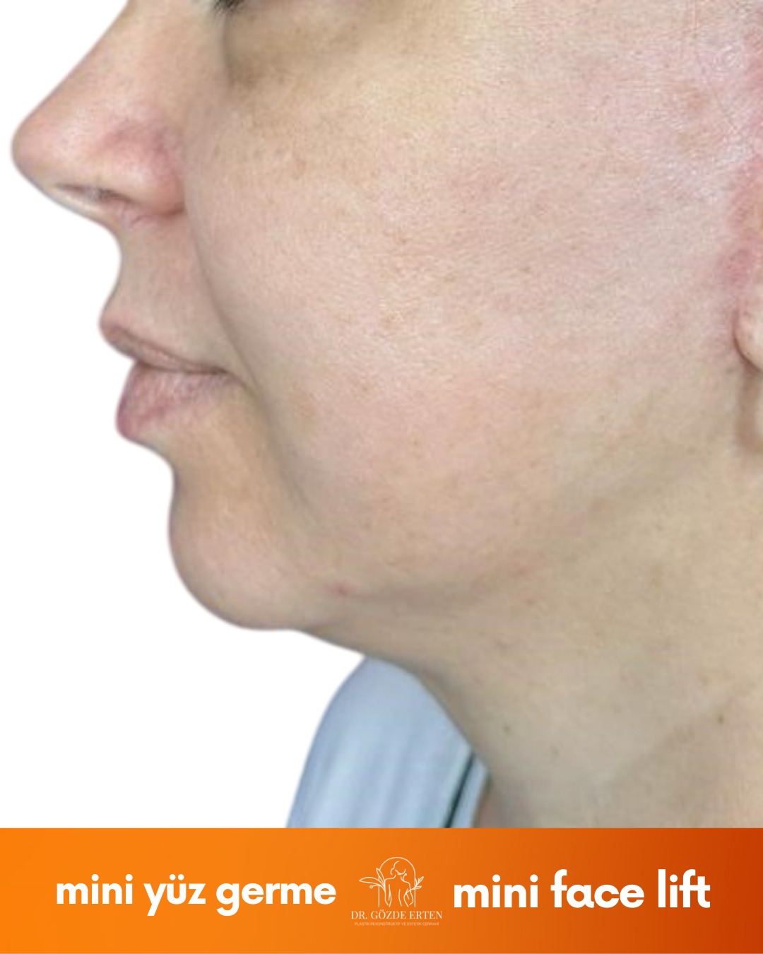 Mini Facelift before and after 6